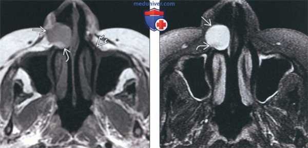 Лучевая диагностика носогубной кисты