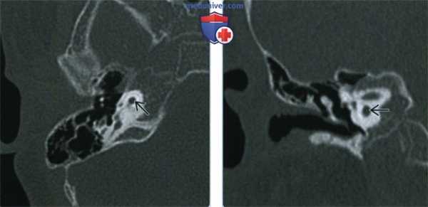 Гипоплазия улитки - лучевая диагностика