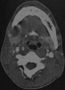 Снимки МРТ и КТ. Абсцесс полости рта