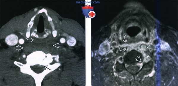 КТ, МРТ при флегмоне паравертебрального пространства
