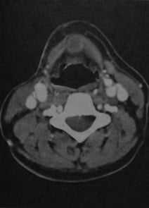 Снимки МРТ и КТ. Щитовидно-язычная киста