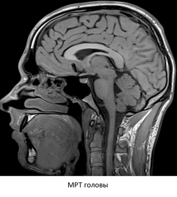 МРТ головы