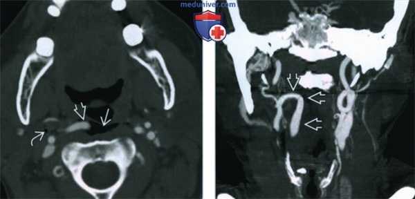 Извитость сонной артерии - лучевая диагностика