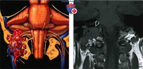 КТ, МРТ при параганглиоме яремного гломуса