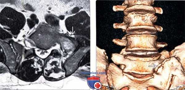 МРТ при синдроме Бертолотти