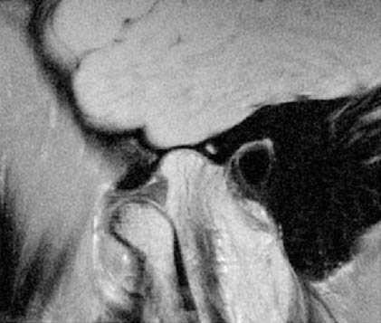 МРТ височно-нижнечелюстных суставов в диагностике заболеваний ВНЧС