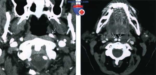 Извитость сонной артерии - лучевая диагностика