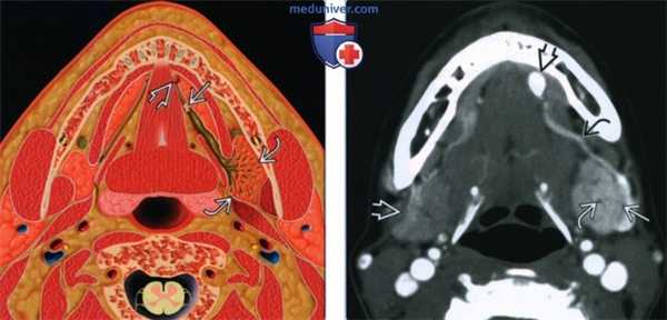 Сиаладенит поднижнечелюстной слюнной железы - лучевая диагностика