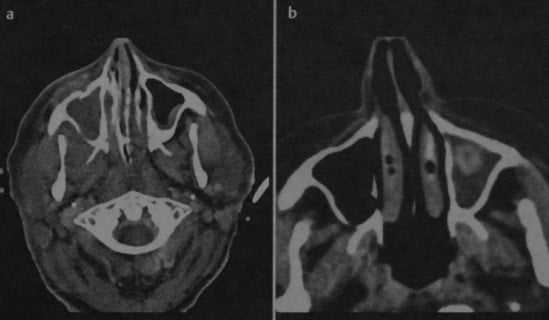 Снимки МРТ и КТ. Грибковая инфекция