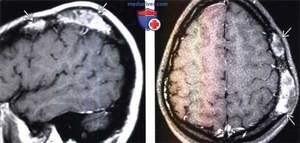 Фиброзная дисплазия на КТ головы