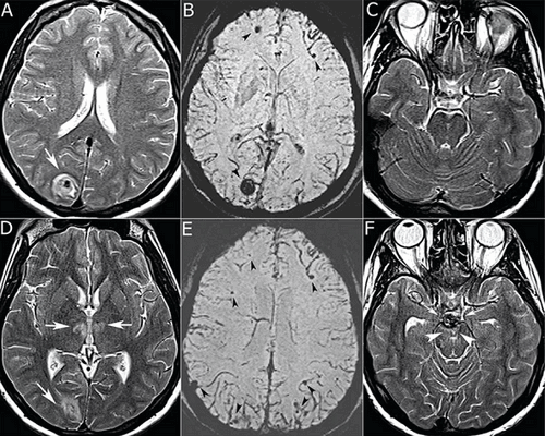 мрт орбит зрительного нерва что показывает