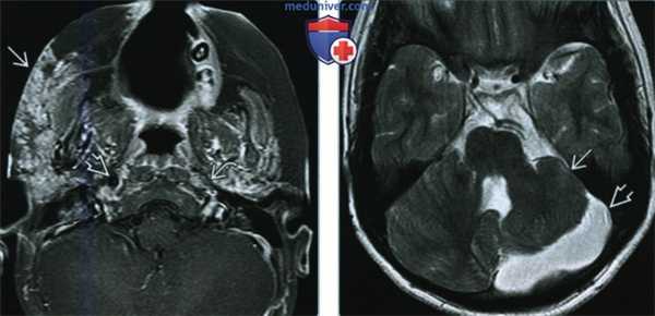 Младенческая гемангиома и синдром PHACES - лучевая диагностика
