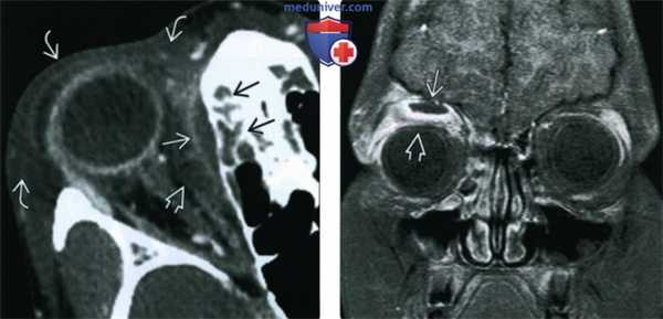 КТ, МРТ при осложнениях риносинусита