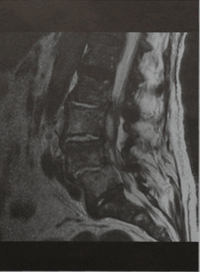 Снимки МРТ и КТ. Эпидуральный абсцесс