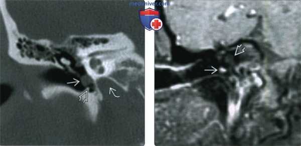 КТ, МРТ при гломусной тимпанической параганглиоме