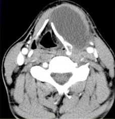щитовидно-подъязычный проток-2-обр