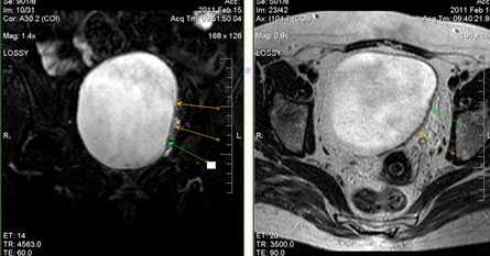 МРТ малого таза в диагностике заболеваний мочевого пузыря