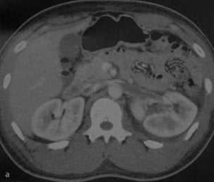 Снимки МРТ и КТ. Тромбоз почечной вены