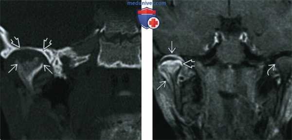 Ювенильный идиопатический артрит височно-нижнечелюстного сустава (ВНЧС) - лучевая диагностика