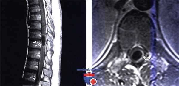 КТ, МРТ при цистицеркозе позвоночника