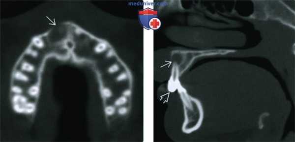 Периапикальная (радикулярная) киста - лучевая диагностика