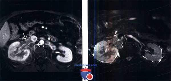 КТ, МРТ при тромбозе почечной вены