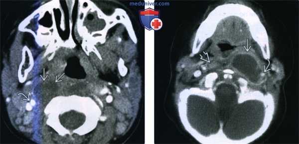 Нагноение заглоточных лимфоузлов - лучевая диагностика