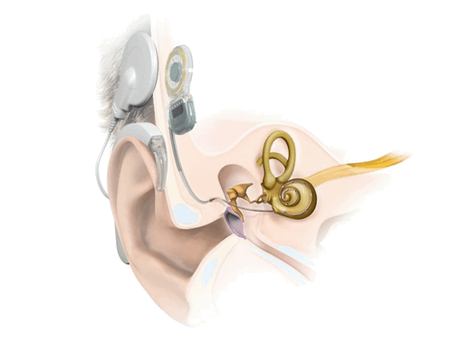 Кохлеарный имплантат