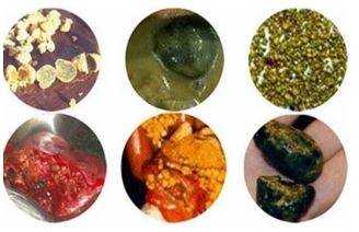 Конкременты в желчном пузыре вариативны по составу, размерам, количеству и форме