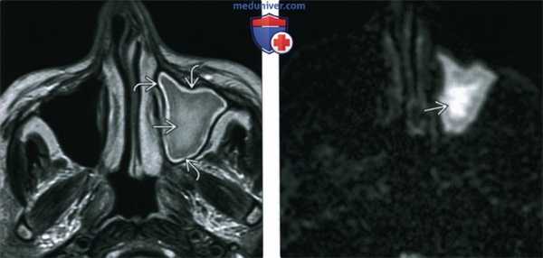 КТ, МРТ при хроническом риносинусите