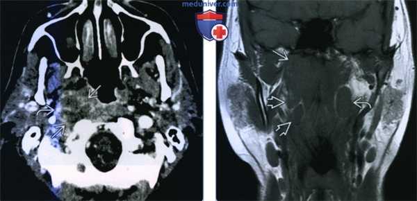Метастазы плоскоклеточного рака в заглоточные лимфоузлы - лучевая диагностика