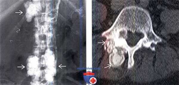 КТ, МРТ при опухолевом кальцинозе позвоночника