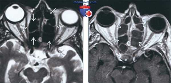 Лучевая диагностика аллергического грибкового синусита