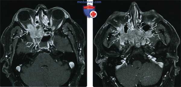 КТ, МРТ при внутричерепном идиопатическом воспалительном псевдотуморе
