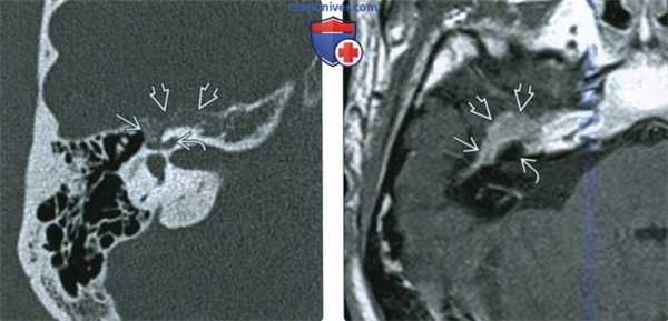КТ, МРТ при венозной мальформации лицевого нерва (ВМЛН) в височной кости
