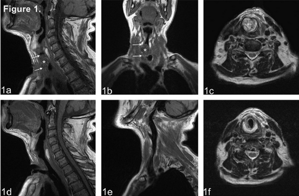 МРТ миндалин