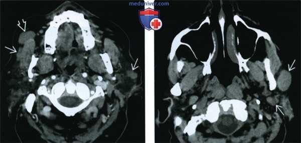 КТ, МРТ при опухоли Вартина
