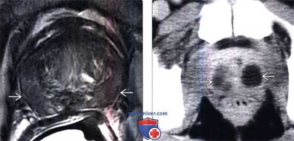 КТ, МРТ при простатите и абсцессе простаты
