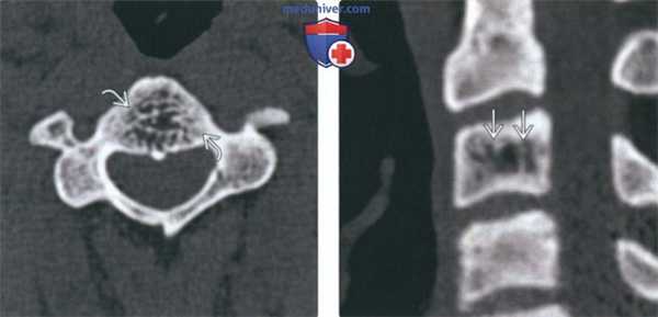 КТ, МРТ при гемангиоме шейных позвонков