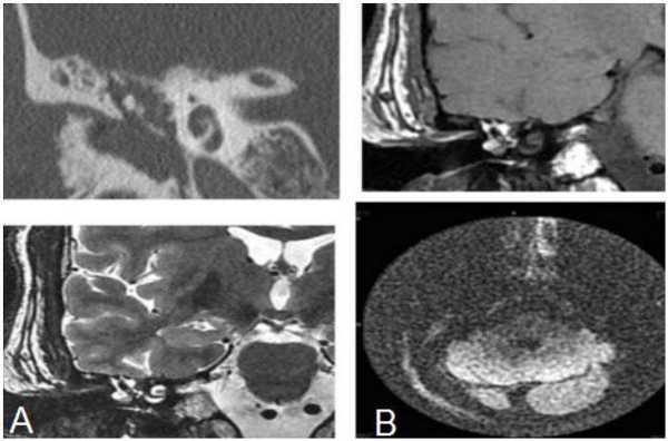 КТ (А) и МРТ(В) - картина холестериновой гранулемы