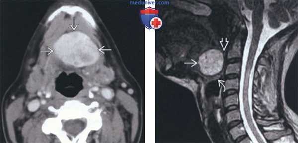 Лучевая диагностика язычной щитовидной железы