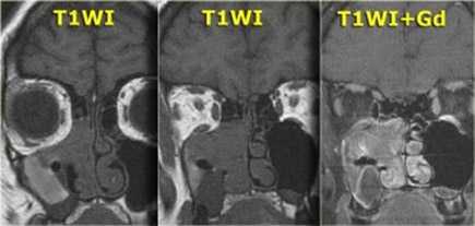  Применение МРТ при заболеваниях придаточных околоносовых пазух