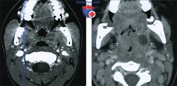Воспаление небных миндалин - лучевая диагностика