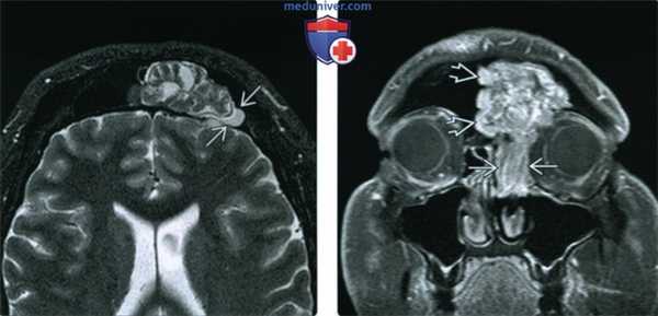 КТ, МРТ при синоназальной инвертированной папилломе