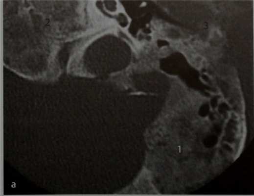 Снимки МРТ и КТ. Фиброзная дисплазия