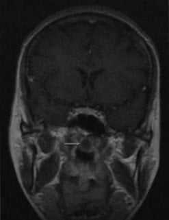 Снимки МРТ и КТ. Киста Торнвальдта - киста носоглотки