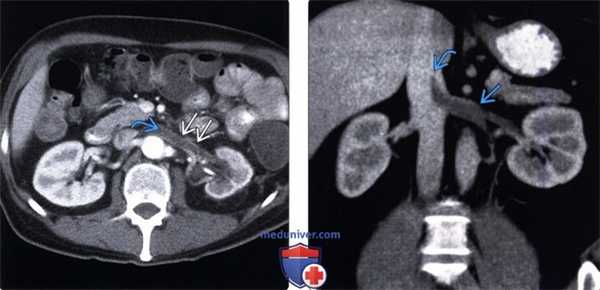 Методы обследования тромбоза почечной вены