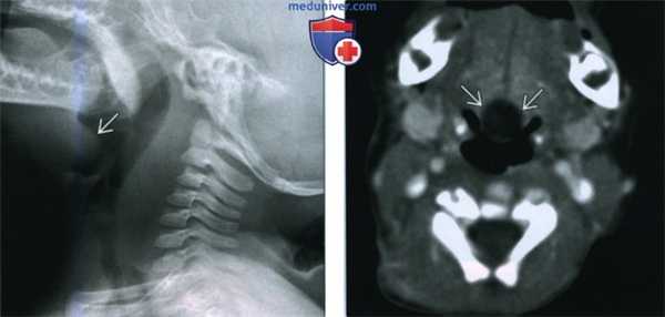 Врожденная киста валлекулы - лучевая диагностика