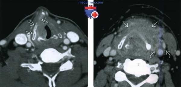 КТ, МРТ при плоскоклеточном раке преддверия гортани