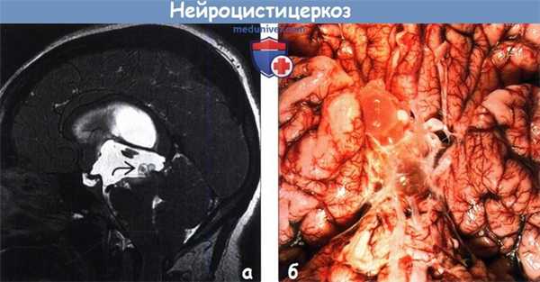 Нейроцистицеркоз на МРТ